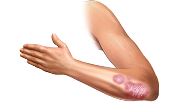 psoriasis Psoriasis